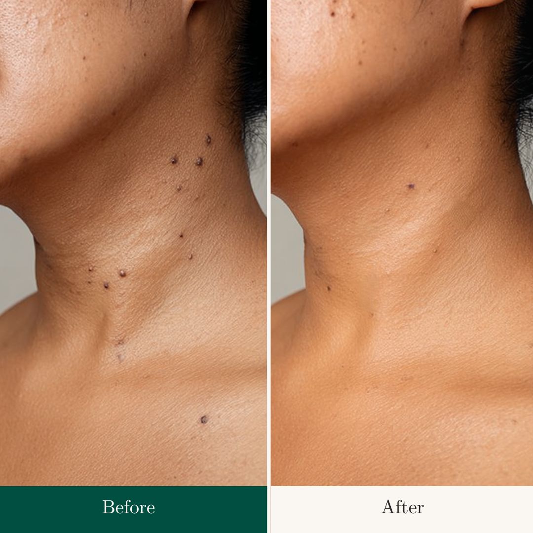 Before After 20